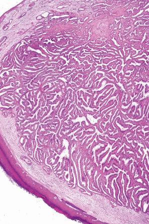 Fig. 33.12, Hidradenoma papilliferum: low-power view of an exophytic ulcerated nodule. The epidermal collarette is seen in the lower left of the field.