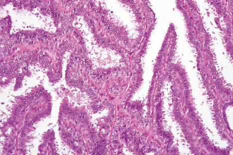 Fig. 33.13, Hidradenoma papilliferum: a double layer of epithelium covers the epithelial fronds. Decapitation secretion is conspicuous.