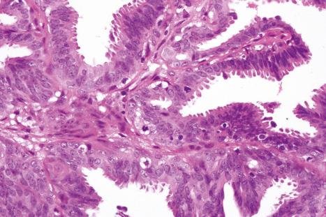 Fig. 33.14, Hidradenoma papilliferum: in the center of the field are two mitotic figures.