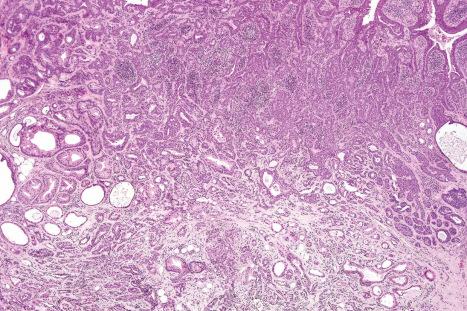 Fig. 33.15, Apocrine tubular adenoma: this example from the face consists of variably sized tubules, many showing cystic dilatation.