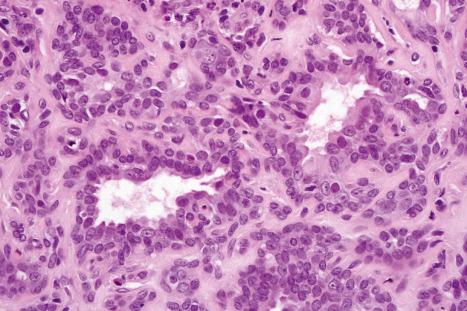 Fig. 33.16, Apocrine tubular adenoma: the tubules are lined by cuboidal to columnar epithelial cells with copious eosinophilic cytoplasm and focally showing decapitation secretion.