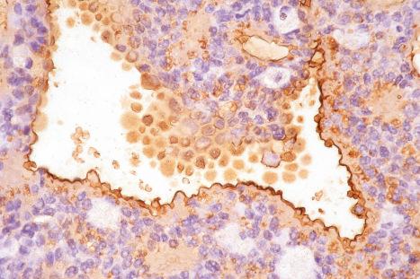 Fig. 33.17, Apocrine tubular adenoma: the luminal aspect of the tubules shows striking EMA positivity.