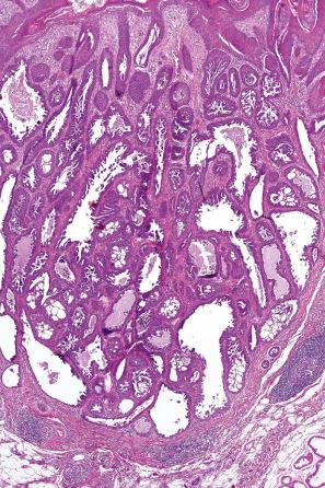 Fig. 33.18, Tubulopapillary hidradenoma: this example, which arose in a background of nevus sebaceous, shows a prominent papillary component.