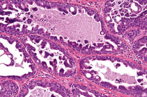 Fig. 33.19, Tubulopapillary hidradenoma: the tubules are lined by double-layered epithelium. The papillae are devoid of a fibrovascular core. It is often impossible to determine whether this tumor is of apocrine or eccrine differentiation.