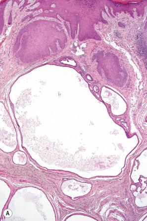 Fig. 33.2, ( A , B ) Apocrine hidrocystoma: this example consists of a multilocular cyst.