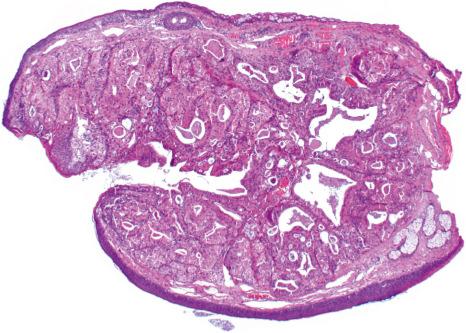 Fig. 33.21, Cutaneous oncocytoma: this well-circumscribed, nodular tumor is located at the mucosal–cutaneous junction of the eyelid and shows connection with the overlying epithelium.