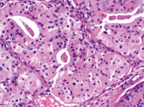 Fig. 33.22, Cutaneous oncocytoma: it is composed of large polygonal cells with abundant brightly eosinophilic and finely granular cytoplasm. Tubular differentiation is evident.