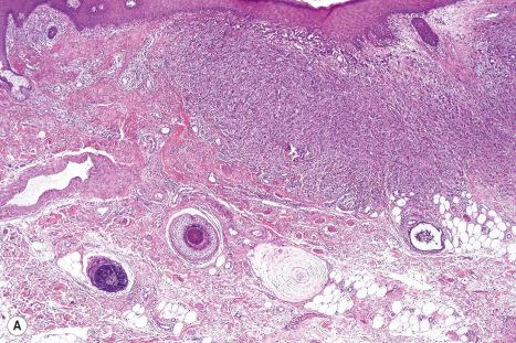 Fig. 33.23, ( A , B ) Apocrine carcinoma: this specimen comes from the vulva and shows diffuse infiltration by poorly differentiated adenocarcinoma. Note the nuclear pleomorphism and prominent nucleoli.