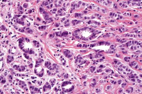 Fig. 33.24, Apocrine carcinoma: focal glandular differentiation and decapitation secretion is evident.