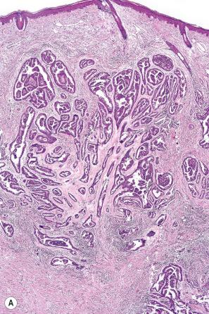 Fig. 33.25, ( A , B ) Apocrine carcinoma: this example from the face shows a striking papillary growth pattern.