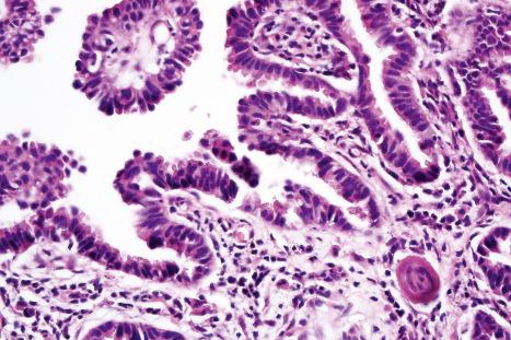 Fig. 33.27, Apocrine carcinoma: there is focal decapitation secretion.