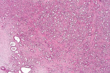 Fig. 33.29, Apocrine carcinoma: low-power view.