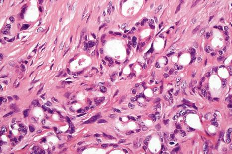 Fig. 33.30, Apocrine carcinoma: the tumor cells have abundant eosinophilic cytoplasm and large vesicular nuclei. Note the nuclear pleomorphism.