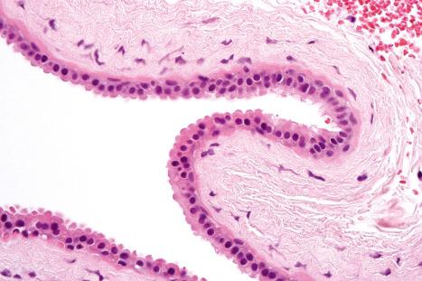 Fig. 33.3, Apocrine hidrocystoma: high-power view of lining epithelium showing decapitation secretion.