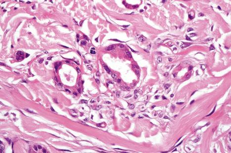 Fig. 33.31, Apocrine carcinoma: there is focal decapitation secretion.