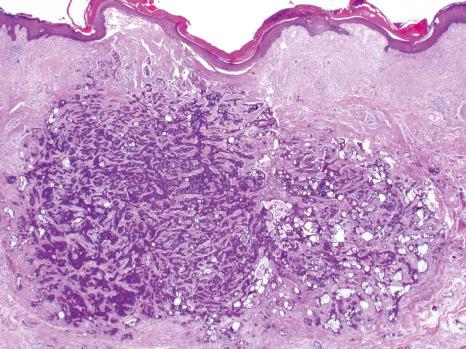 Fig. 33.32, Primary cutaneous cribriform apocrine carcinoma: this nodular tumor is based within dermis. It appears relatively circumscribed but unencapsulated.