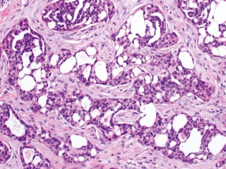 Fig. 33.33, Primary cutaneous cribriform apocrine carcinoma: it is composed of small epithelioid cells without nuclear pleomorphism. Prominent duct formation gives rise to the cribriform appearances.