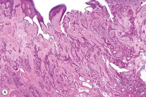 Fig. 33.34, ( A , B ) Ceruminous gland adenoma: this example shows continuity with the epidermis. The tumor shows tubule formation and multiple small cysts are apparent. The tubules are lined by a double layer of epithelium. The inner layer has abundant eosinophilic cytoplasm; the cells of the outer layer are cuboidal and represent myoepithelial cells.