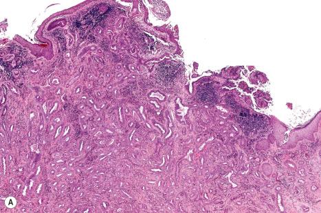 Fig. 33.35, Ceruminous gland adenocarcinoma: ( A ) low-power view of part of an ulcerated mass; ( B ) there is multilayering and nuclear pleomorphism.