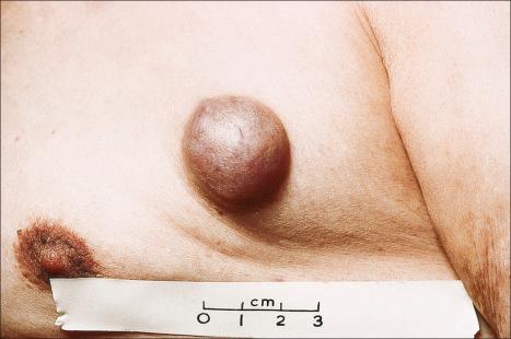 Fig. 33.37, Mixed tumor: lesions are more common in males and occasionally affect the thorax.