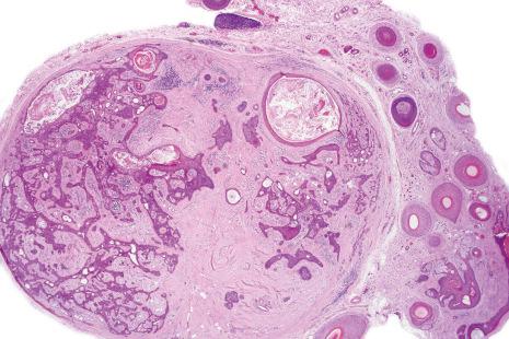 Fig. 33.38, Mixed tumor: at scanning magnification, the tumor is circumscribed and compresses the adjacent dermal connective tissue.