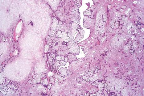 Fig. 33.39, Mixed tumor: this example has a well-developed chondroid stroma. There is conspicuous ductal differentiation and multiple cysts are present.