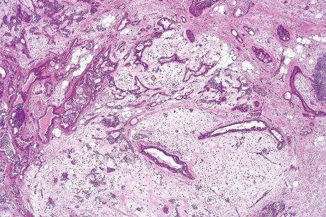 Fig. 33.40, Mixed tumor: higher-power view of chondroid component.