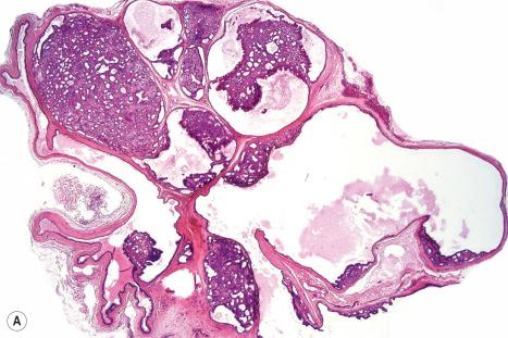 Fig. 33.4, ( A , B ) Apocrine papillary cystadenoma: this tumor (which presented on the skin of the neck) was cystic but contained both adenomatous and papillary components.