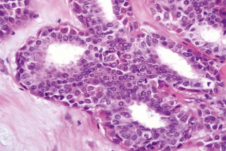 Fig. 33.41, Mixed tumor: the inner lining cells have abundant cytoplasm and vesicular nuclei; the outer myoepithelial cells have hyperchromatic spindled nuclei.