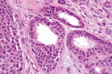 Fig. 33.42, Mixed tumor: this example shows well-developed decapitation secretion.