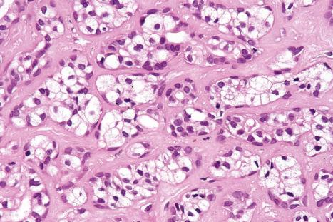 Fig. 33.43, Mixed tumor: clear cell change due to cytoplasmic glycogen is sometimes present.