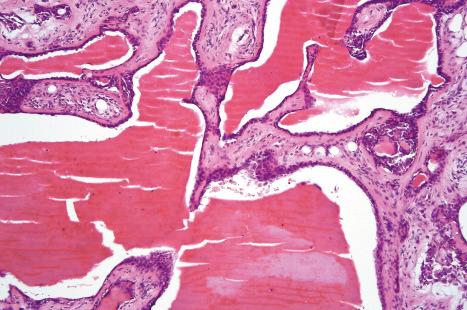 Fig. 33.45, Mixed tumor: this example shows marked cystic change.