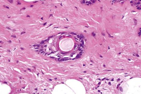 Fig. 33.46, Mixed tumor: keratocysts, as shown in this field, are sometimes present.