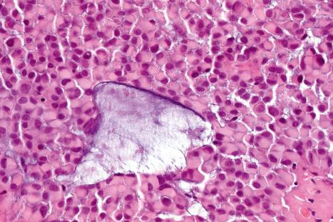 Fig. 33.47, Mixed tumor: this example shows conspicuous hyaline/plasmacytoid cells.