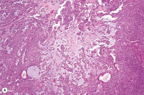 Fig. 33.48, Mixed tumor: ( A , B ) in this field, the stroma has a chondroid appearance; ( C ) this example shows well-developed bone with marrow cavities.