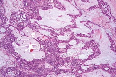 Fig. 33.49, Mixed tumor: myxoid change due to abundant mucopolysaccharide is commonly present.