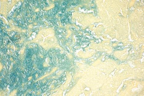 Fig. 33.50, Mixed tumor: the stroma stains strongly with Alcian green.