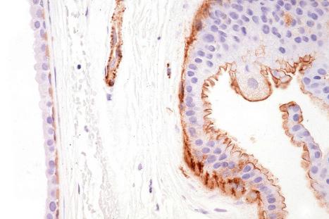 Fig. 33.5, Apocrine hidrocystoma: the outer myoepithelial cells express smooth muscle actin.