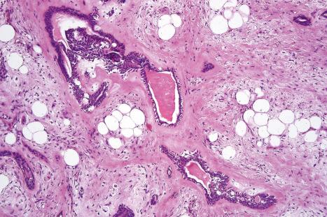 Fig. 33.51, Mixed tumor: foci of mature adipocytes are often an integral component of the tumor.