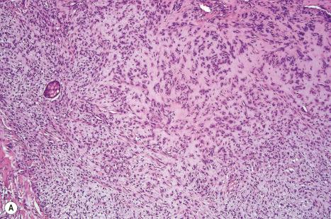 Fig. 33.52, ( A , B ) Mixed tumor: eccrine variant showing small, ductlike structures dispersed in a hyalinized stroma.