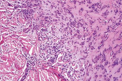 Fig. 33.53, Mixed tumor: focal clear cell change is seen in this example.