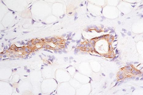 Fig. 33.54, Mixed tumor: the inner layer of epithelial cells shows strong EMA expression.