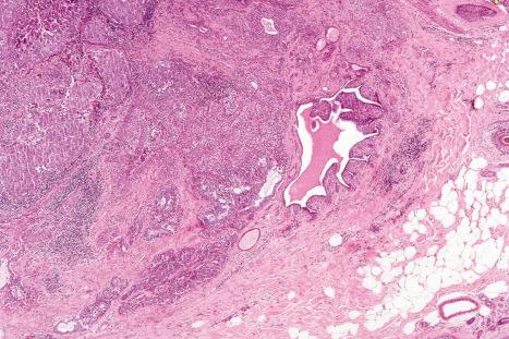 Fig. 33.56, Malignant mixed tumor: this specimen comes from a longstanding lesion. Residual benign precursor is seen to the right of center.