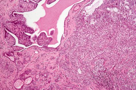 Fig. 33.57, Malignant mixed tumor: benign tumor on the left merges with carcinoma on the right.