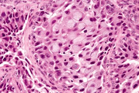 Fig. 33.59, Malignant mixed tumor: focally, the tumor cells show signet ring cell change.