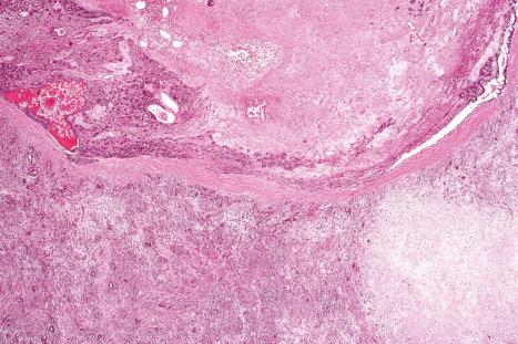 Fig. 33.60, Malignant mixed tumor: this example is a recurrent lesion on the foot. Residual benign tumor is present in the upper-left quadrant. Chondroid stroma is evident in the lower-right field.