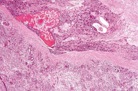 Fig. 33.61, Malignant mixed tumor: residual benign tumor showing cysts and ducts lined by a double-layered epithelium. Carcinoma is present in the lower field.