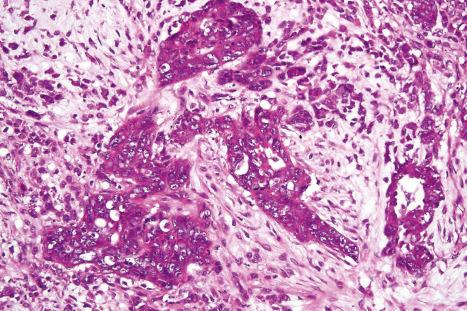 Fig. 33.62, Malignant mixed tumor: the malignant component shows focal glandular differentiation.