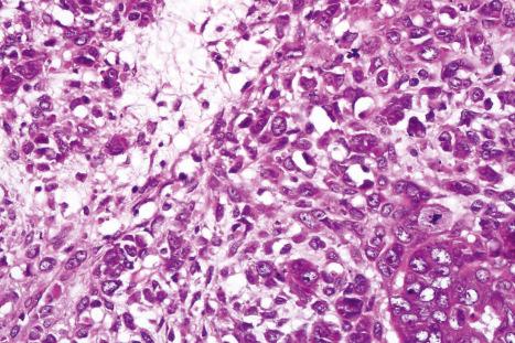 Fig. 33.63, Malignant mixed tumor: note the nuclear pleomorphism and mitotic activity.