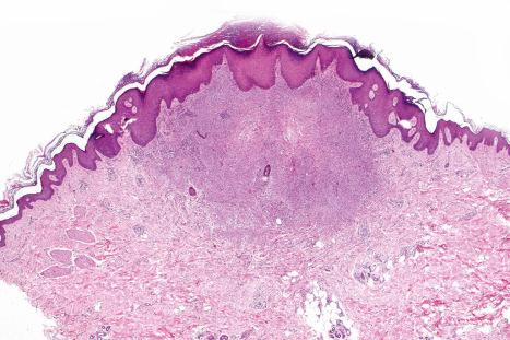 Fig. 33.64, Myoepithelioma: scanning view showing a circumscribed upper dermal tumor nodule.